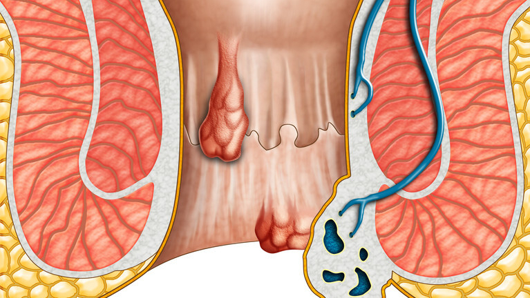 肛门息肉图和痔疮图片(屁股上有肉球) - 赤虎壹号