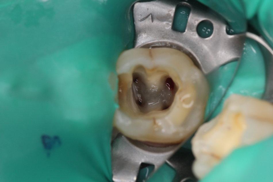 抽完牙神经后,牙齿变成"死牙"?还能要吗?