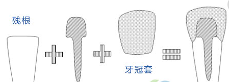 有些牙根是不用拔除的，你知道吗？  （口腔科普第四十五期）