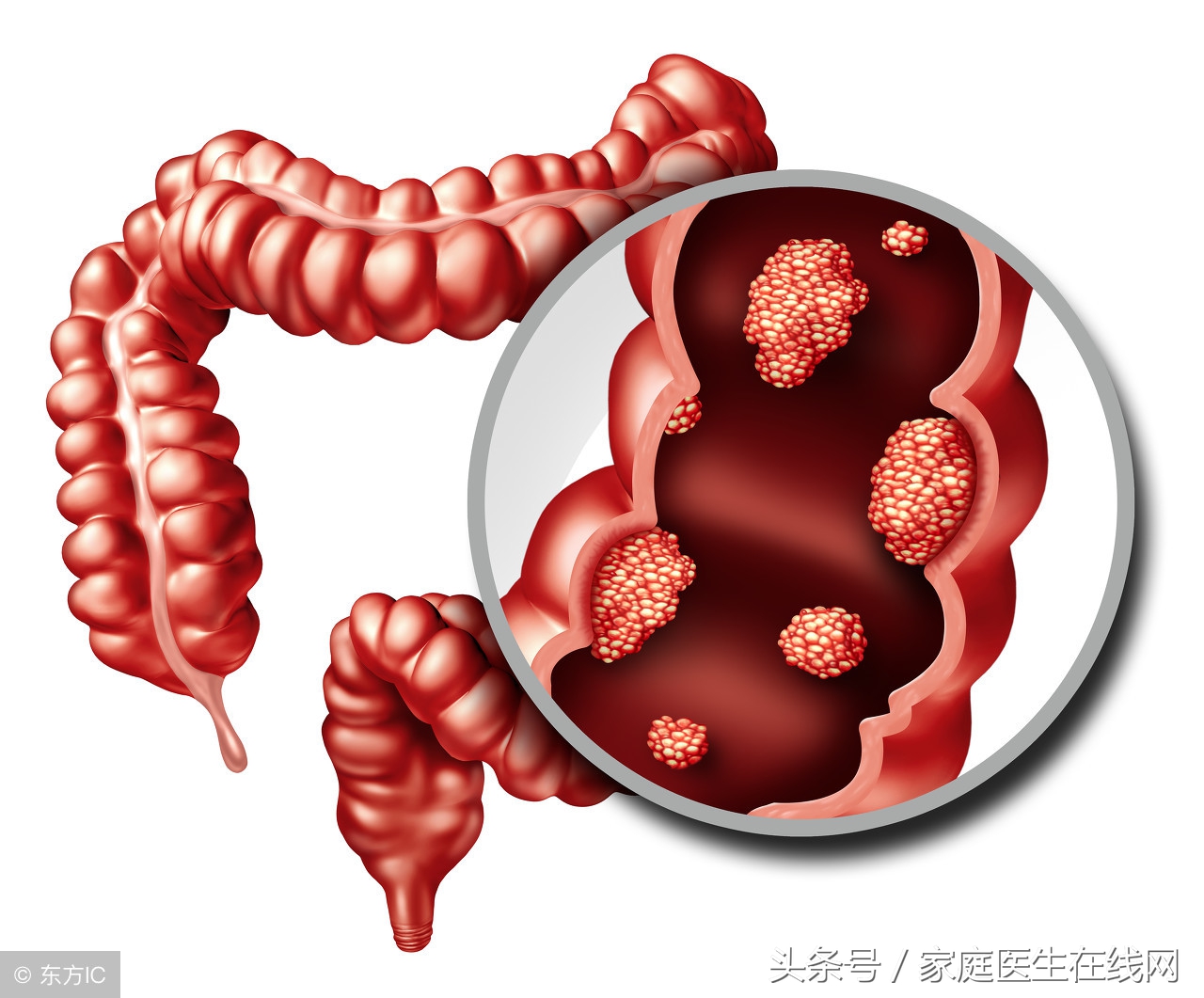 直肠息肉治疗方案及预防直肠癌的关键措施