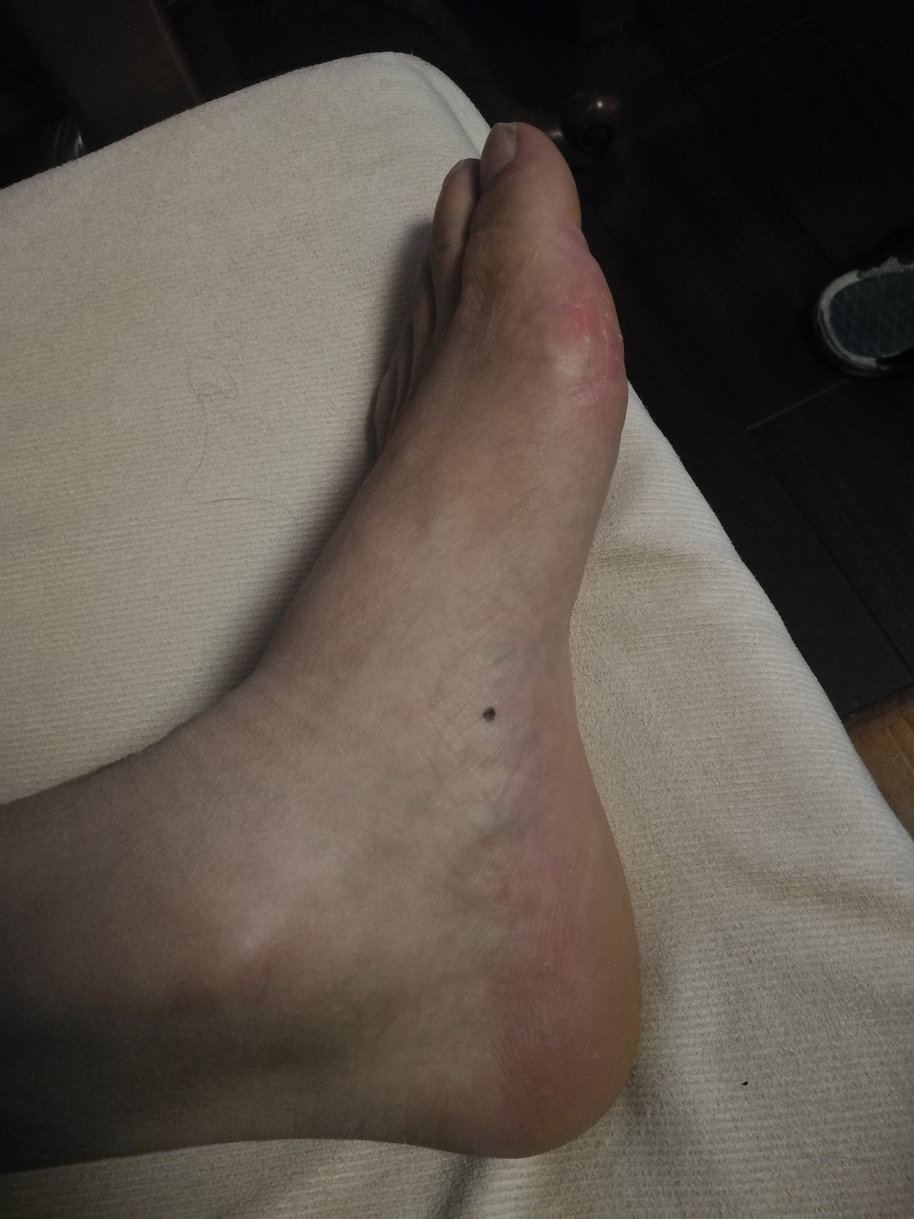 相术:图解——脚上长痣