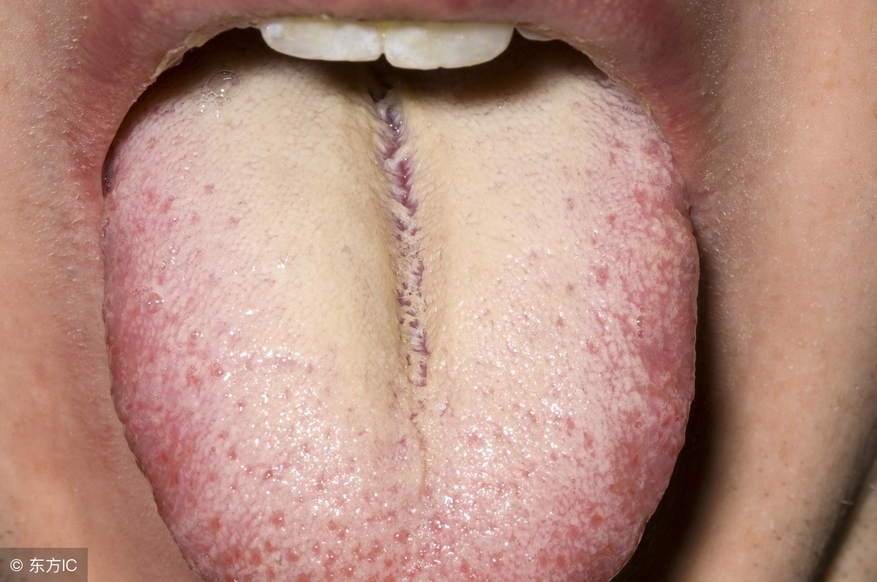 胃阴虚舌苔图片(中医辨证) - 赤虎壹号