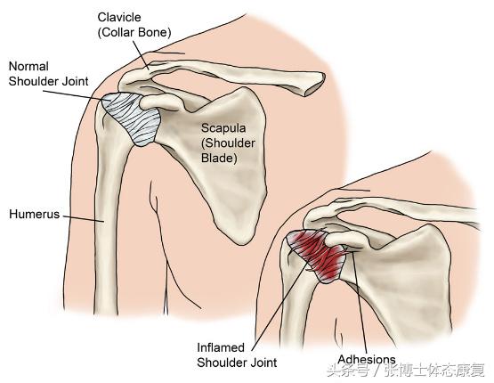 肩关节屈曲和伸展图片(「运动康复科普」关于肩周炎（五十肩）的发生机制与康复方法)