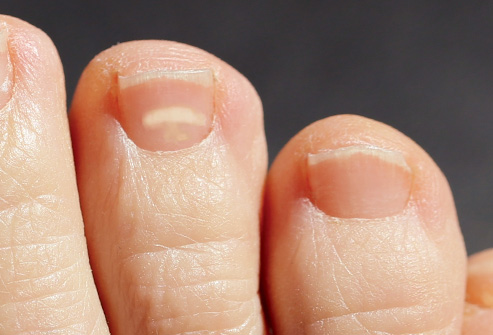 趾甲变黄,黑,绿分别是啥疾病的信号?该如何处理?多图详解