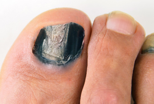 脚甲黑色素瘤的图片图片