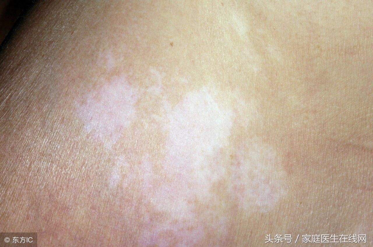 白癜风是如何发生的？为何偏偏是你患上了这种病？
