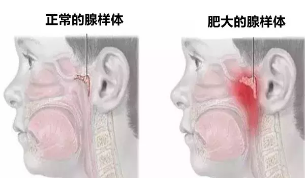 张口呼吸会变丑？4种方法快速鉴别，快看你家宝宝有没有！