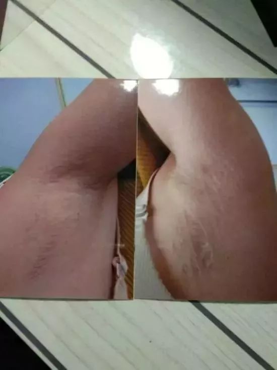 女子突然暴肥,竟是前夫下黑手,给她注射了69支激素?