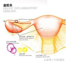 世界杯气死了(老公只顾着看“世界杯”，二胎妈妈累出了“盆腔炎”!)