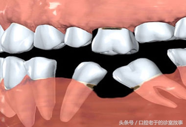 老人牙都掉完了，镶全口假牙是最好的选择吗？