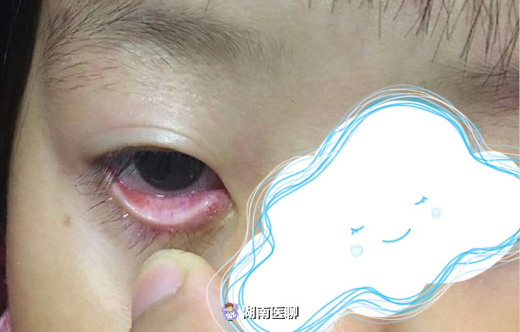 女童患血管瘤,右下眼皮长红色肿块,曾以为麦粒肿越治越重