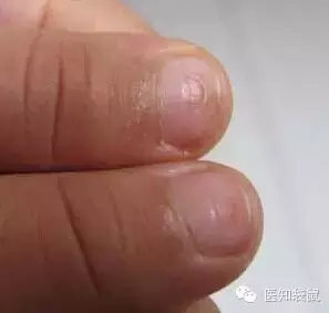宝宝指甲透露出健康状况!长倒刺、有凹痕要警惕这些病!