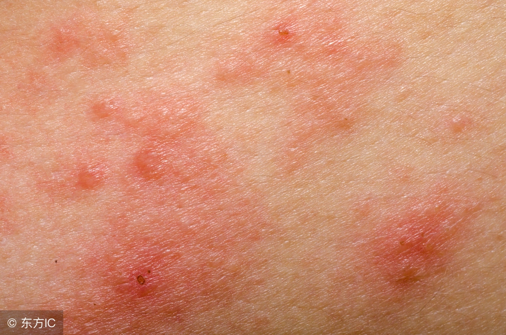 常见的湿疹主要症状有哪些？几种特殊类型湿疹的症状表现