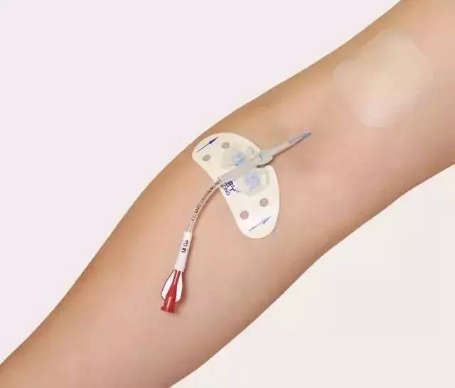 被称为"化疗神器"的输液港,究竟是什么?