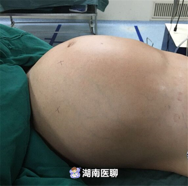 小痛小病莫轻视！阑尾炎的小阵痛拖久了可致命