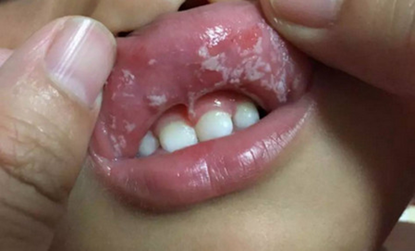 宝宝出现鹅口疮该怎么办呢?