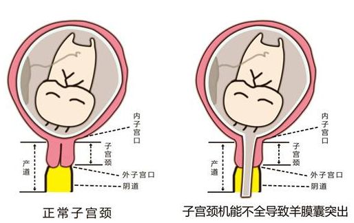 宫颈机能不全(cervical incompetence,cic)是指宫颈先天发育不良或