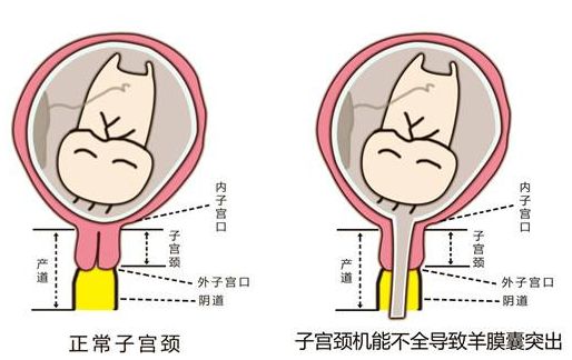 使宫颈缩短,宫颈内口松弛导致宫颈内口在非孕状态下病理性扩张的现