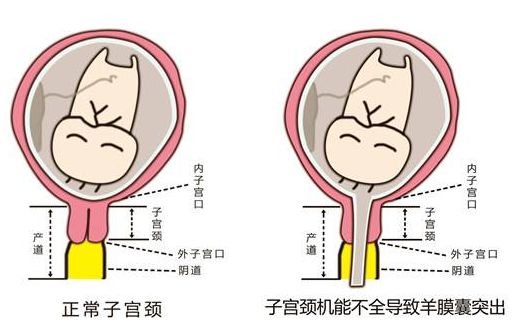 宮頸機能不全反覆自然流產的媽媽,宮頸環扎術為您帶來