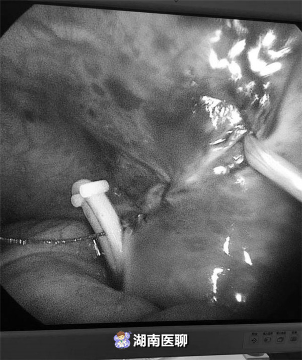 2岁宝宝先天睾丸“错位”，医生腹腔镜下手术送它“回家”