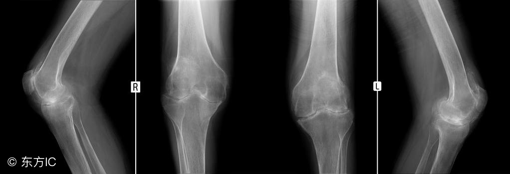 骨关节炎,风湿性关节炎,类风湿关节炎,看看你是哪一款?