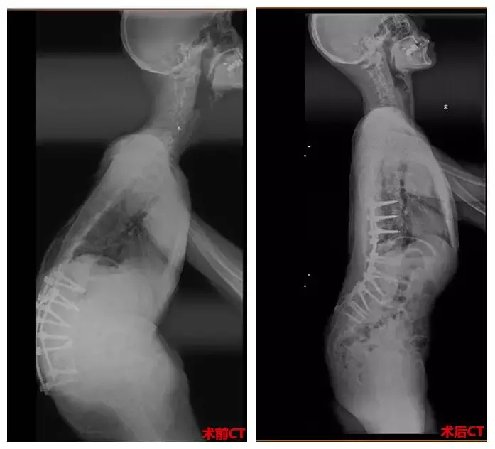 “强直”驼背腰痛二十年，在暨大附属第一医院截骨矫形成功治愈