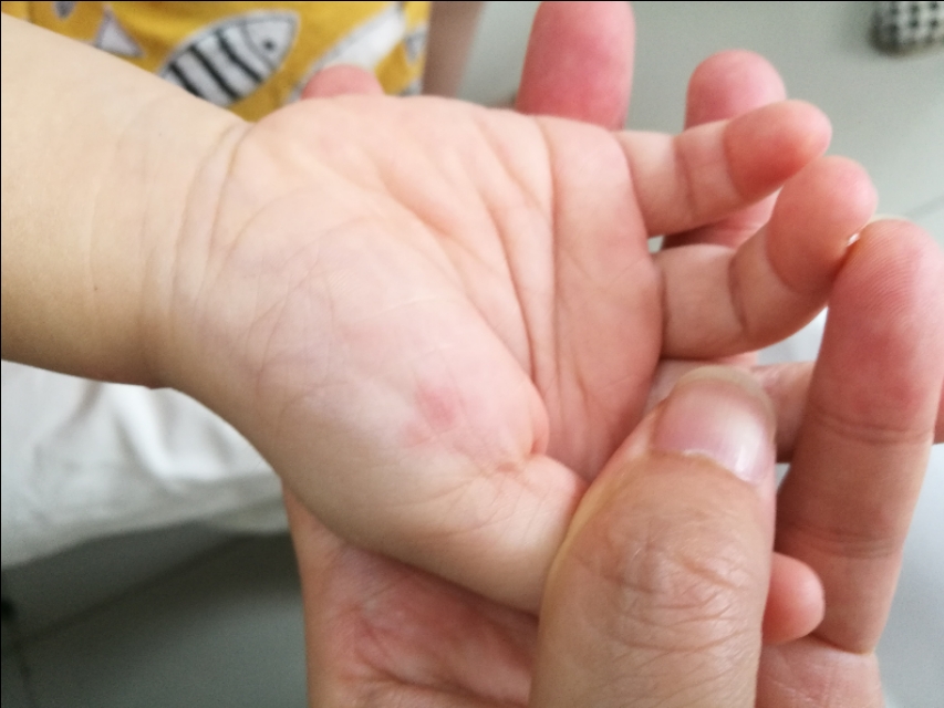 才21个月大的宝宝,居然得了带状疱疹,与成人有何不同?