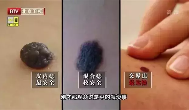 这5种“痣”竟是潜在的“癌中之王”!快看看你身上有没有