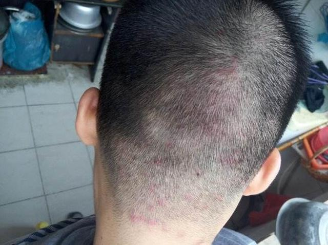 头皮螨虫的症状图片(头螨为啥叫) - 赤虎壹号