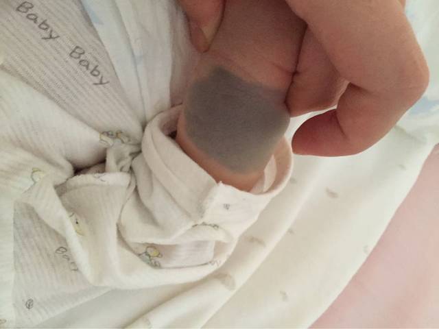 宝宝出生以后,手背上出现了胎记,怎么处理才是最合适的?