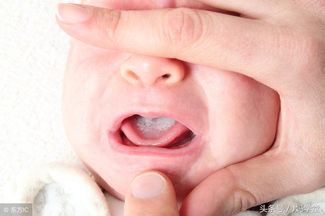 儿童口腔鹅口疮:原因、症状和治疗|耳、鼻、喉和牙齿问题文章|身体和健康状况中心| SteadyHealth.com - 雷竞技RAYBET官网