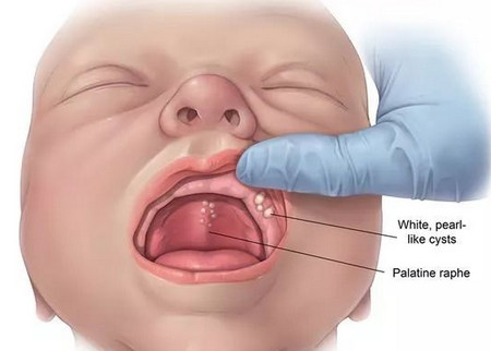 婴儿嘴巴上面长一层白图片