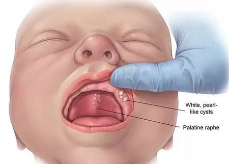 新生宝宝长“马牙”焦躁不安？盲目处理容易引发炎症