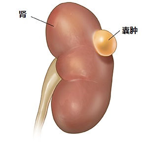 体检发现肾囊肿，必须要治疗吗？不治疗会不会恶化成尿毒症？