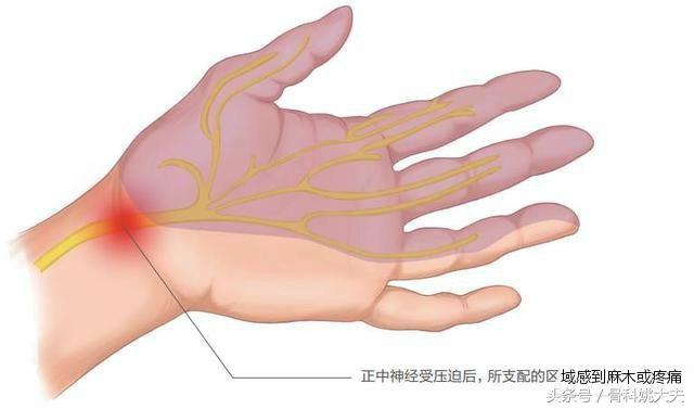 手指麻木怎么办？记住这八点，分分钟就找到病因！