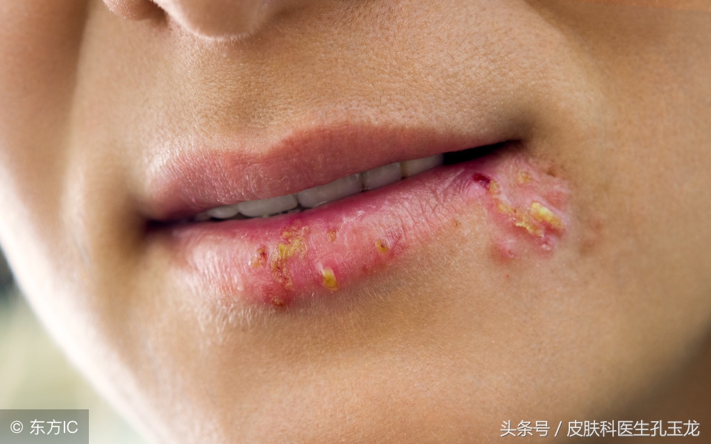 皮肤科常见疾病:嘴唇上火的真相——单纯疱疹