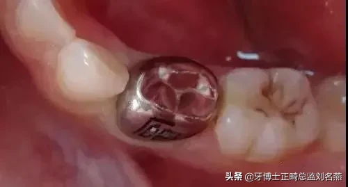 什么是预成冠?儿童乳牙的保护伞