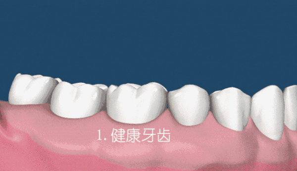 牙齿掉渣是什么原因？牙釉质脱落要重视，别因为侥幸毁了一口牙