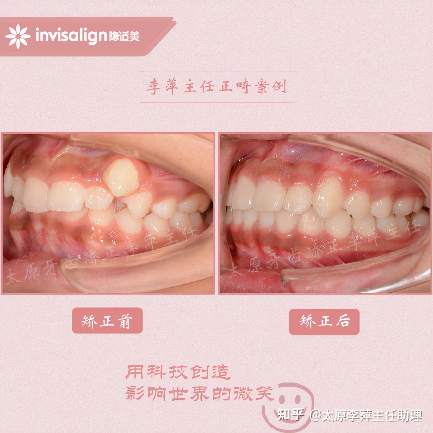 太原牙齿矫正：隐形牙套效果好不好？看这些病例你就知道了