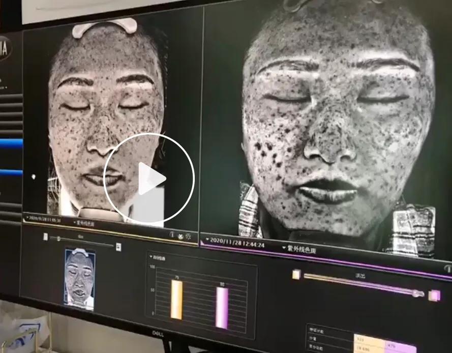 3次祛斑经验，终于和斑点说再见了