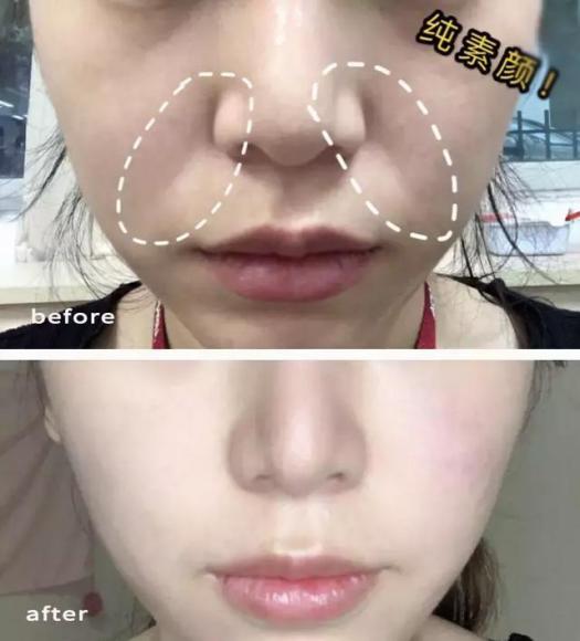 让日本女人夜夜疯狂的神器，法令纹、眉间纹克星！一贴＝10次除皱