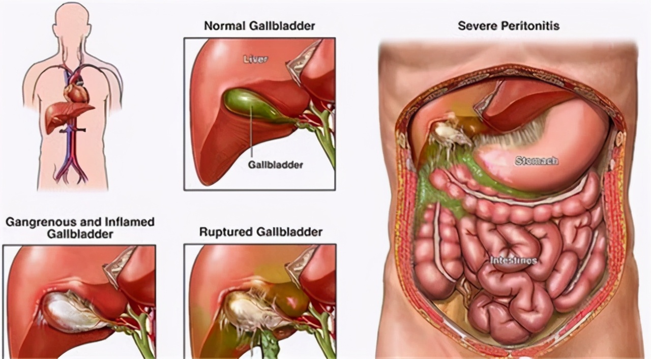胆囊切除对身体有何影响？后遗症不好受，除非万不得已，别切