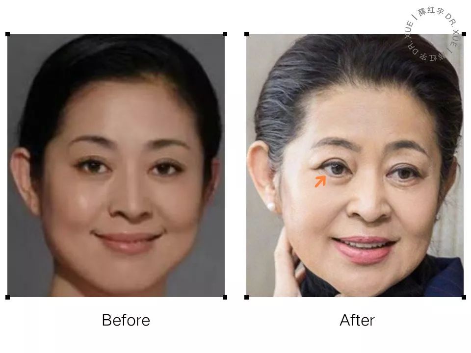 要不要开外眼角？要不要做眼睑下至？