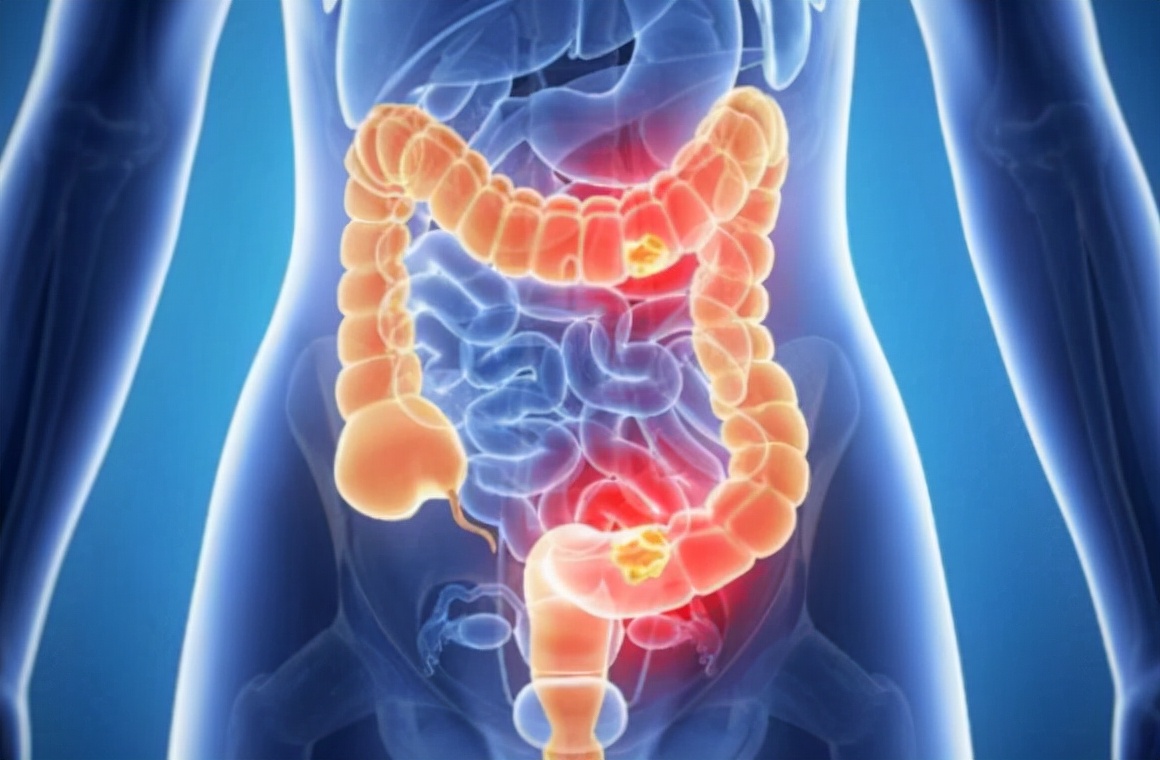 阑尾真的是毫无用处想割就割吗?会有哪些后遗症?