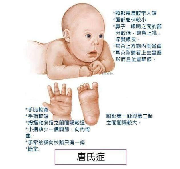有唐氏综合征的新生儿面部是什么样子的?