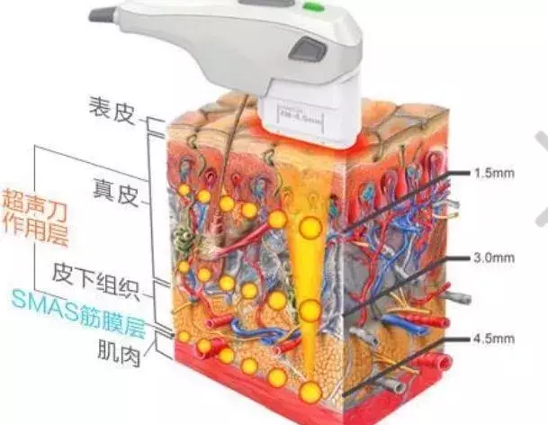 超声刀vs热玛吉，你的钱到底该怎么花？