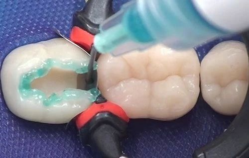 牙缝大修复多少费用(补牙齿缝隙需要多少钱)