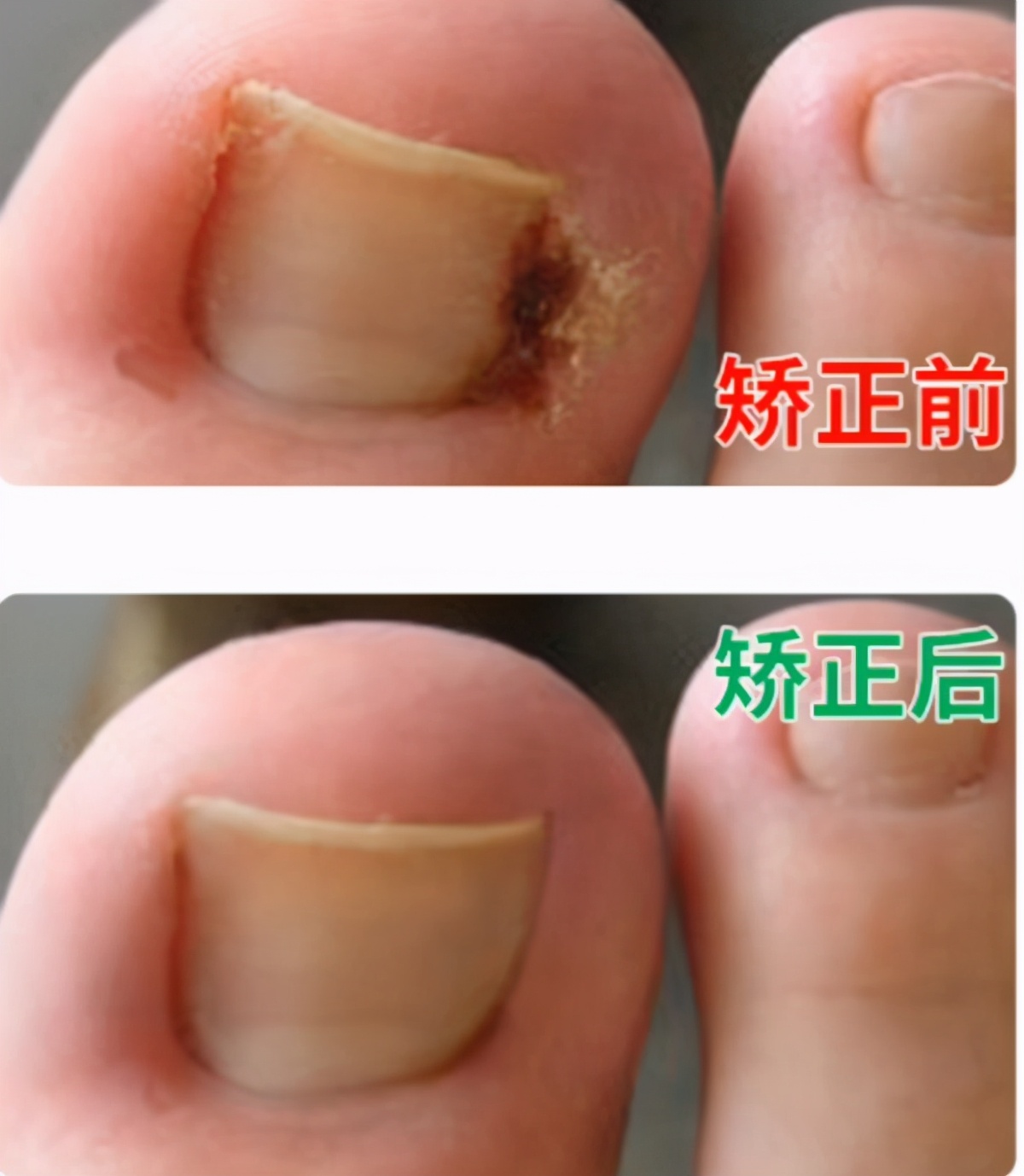 皮肤科普:甲沟炎,嵌甲,疼痛难忍,影响行动,一定要拔甲吗?