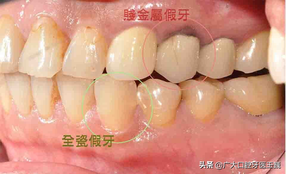 氟斑牙治療方法及價格全瓷牙和烤瓷牙的區別