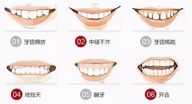 深覆颌矫正多少钱牙齿矫正贵在哪里